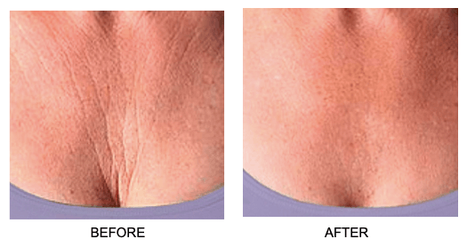 Chest Wrinkle Patch | Reusable Skin Plumping Chest Mask
