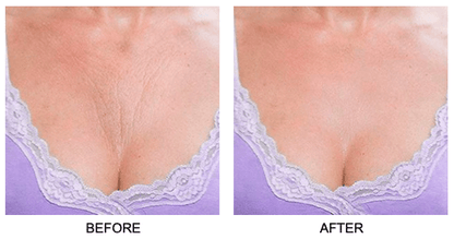Chest Wrinkle Patch | Reusable Skin Plumping Chest Mask